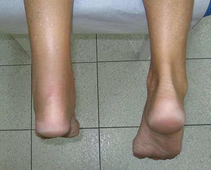 Achilles Tendon Injuries