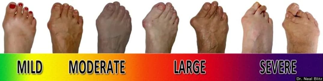 Bunion Symptoms and Identification - Podiatry health article from FALL Clinic Perth