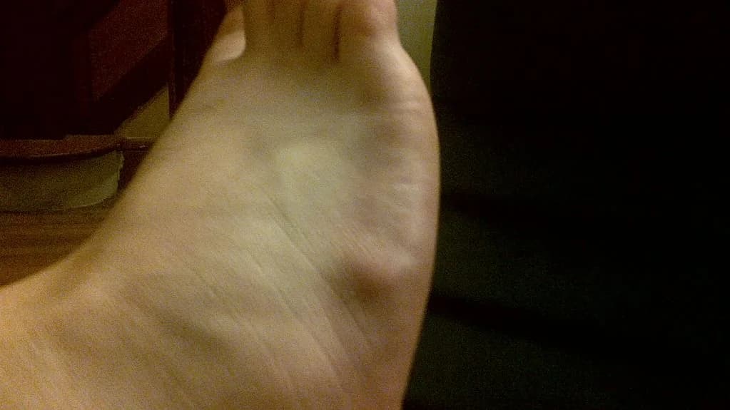 What is a Ganglion? - Related podiatry article from FALL Clinic Perth