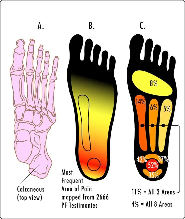 Heel and Arch Pain