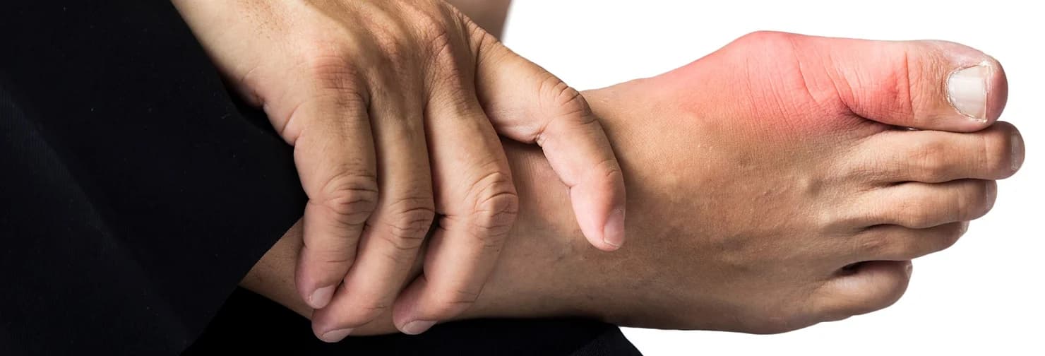 Gout (or Podagra) - Related podiatry article from FALL Clinic Perth