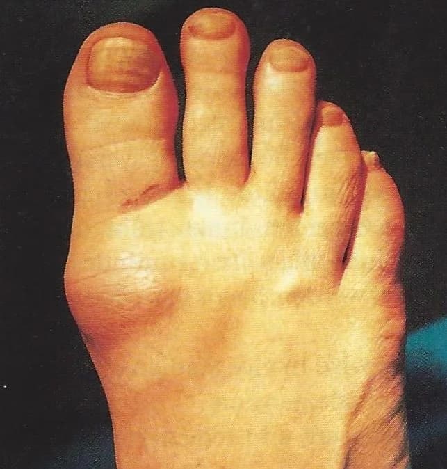 Stiff Big Toe (Hallux Rigidus) - Related podiatry article from FALL Clinic Perth