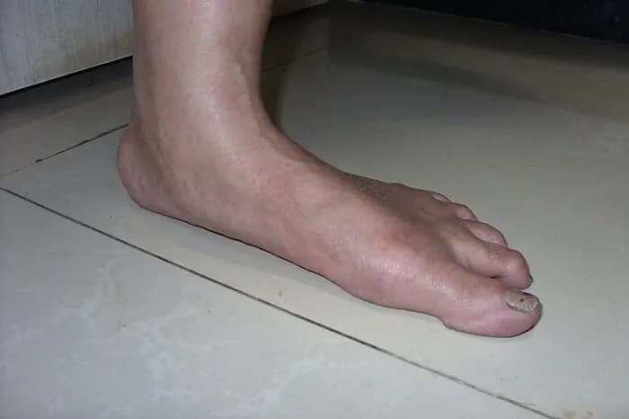 Flat Feet
