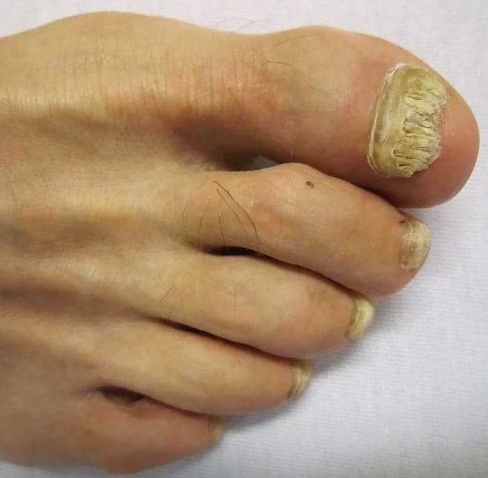 Fungal Nails