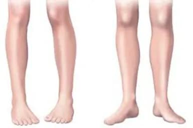 In Toed Gait