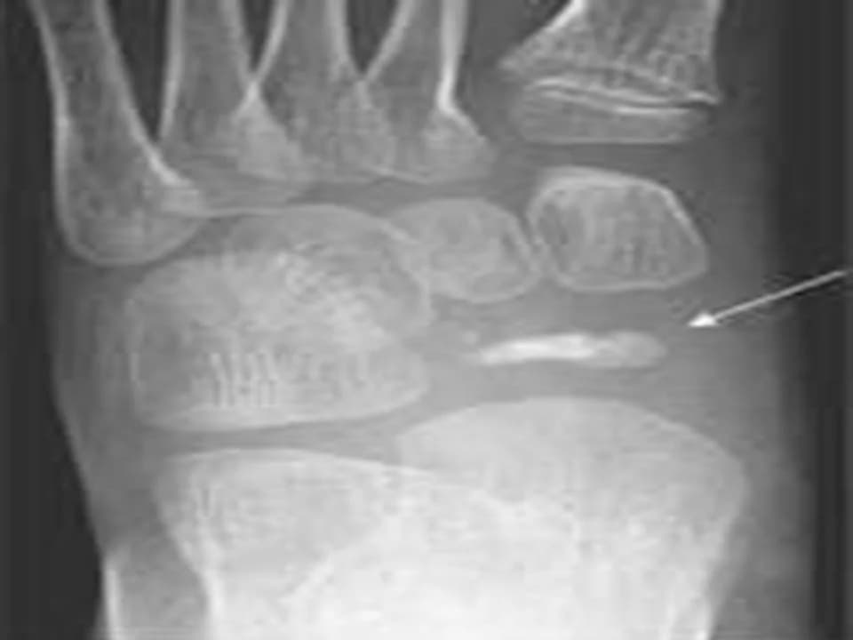 Köhler’s Disease - Podiatry health article from FALL Clinic Perth
