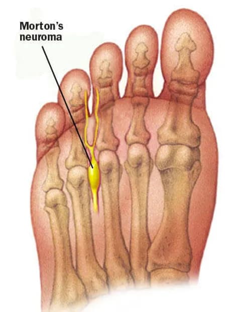 Morton’s Neuroma