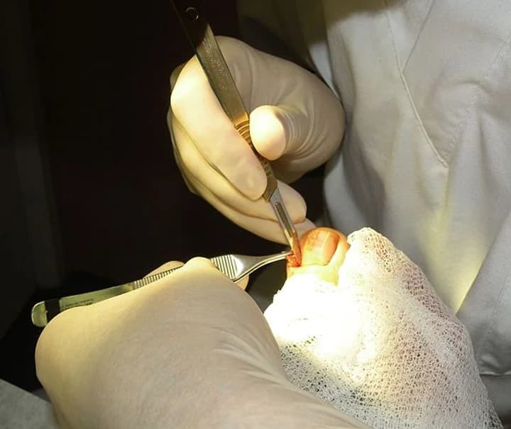Ingrown Toe Nail Treatment: 7 Reasons Why You Should Come To Us