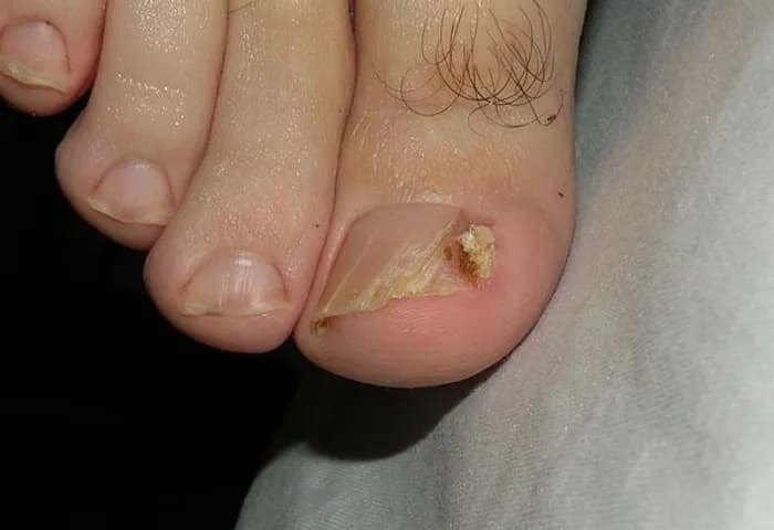 Ingrown Toenails