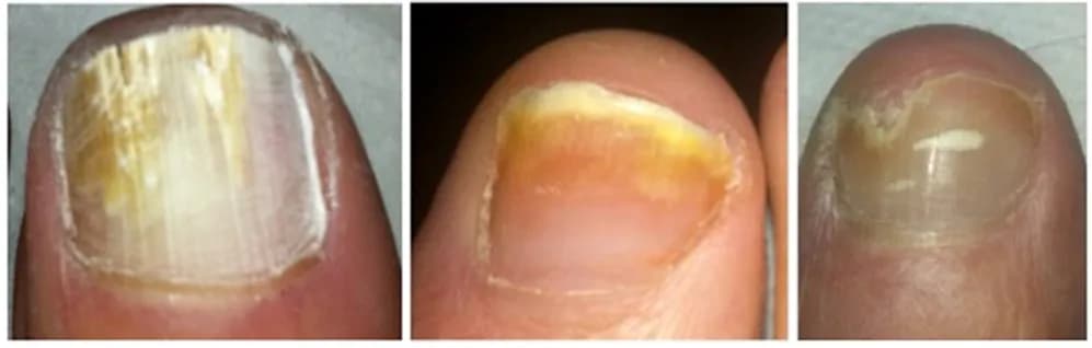 Fungal Nail Infections