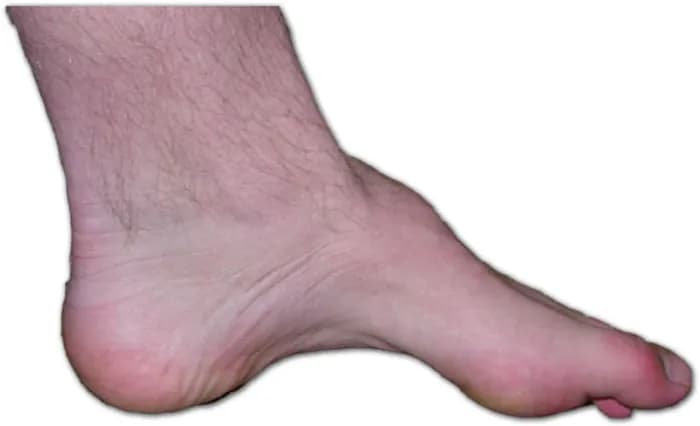High Arch Foot (Pes Cavus)