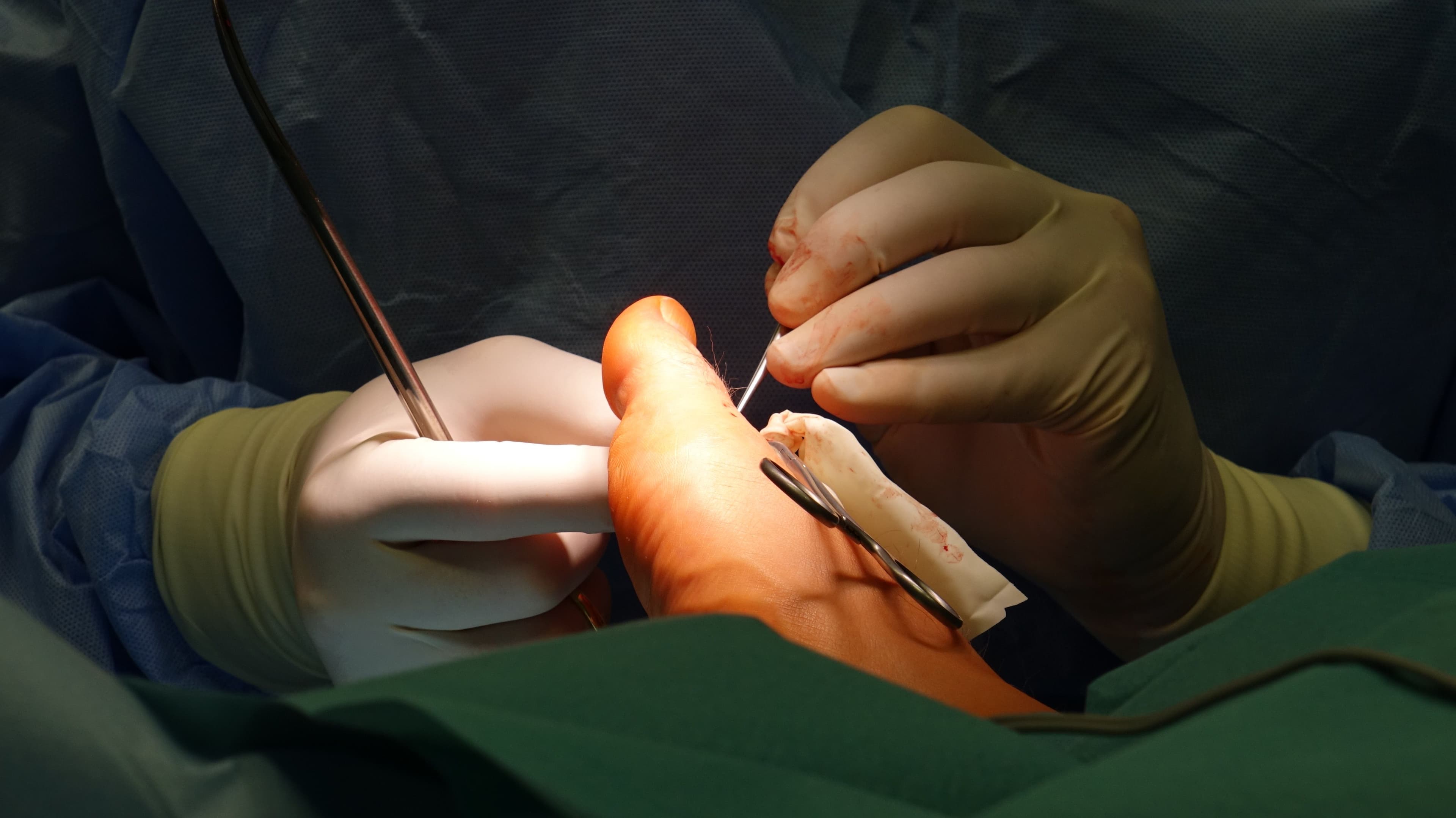 Should I treat my ingrown nail permanently? - Podiatry health article from FALL Clinic Perth