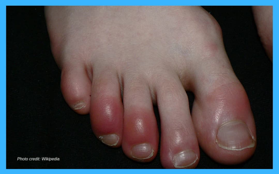 Chilblains - Related podiatry article from FALL Clinic Perth